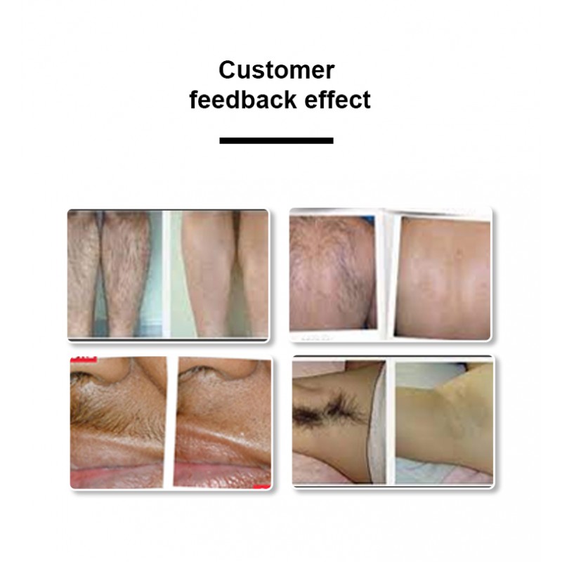 2 Years Warranty 3000w High Power 808nm Fiber Coupled Diode Laser Hair Removal Epilator Hair Removal Machine 