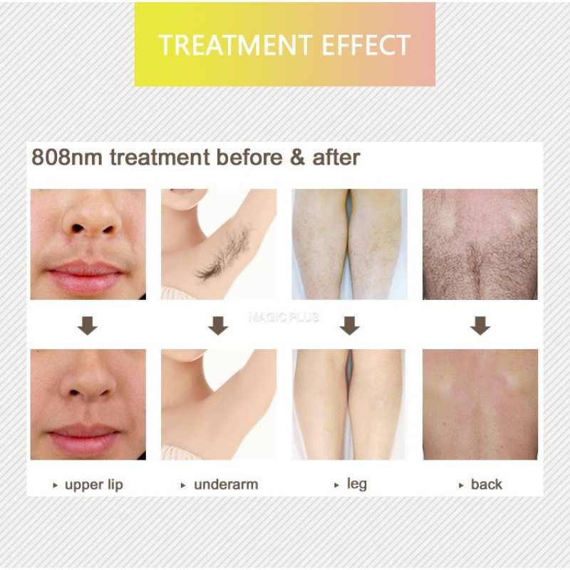 Professional Big Power Laser Hair Removal 755 808 1064nm Ice Permanently Skin Rejuvenation Diode Laser Hiar Removal Machine 