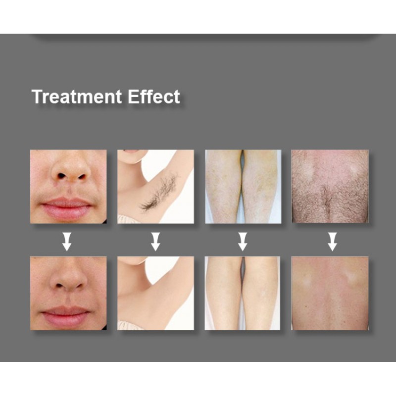 OEM ODM professional Pico diode pigment removal Q-switch Nd YAG carbon skin pigment tattoo removal machine CE factory 