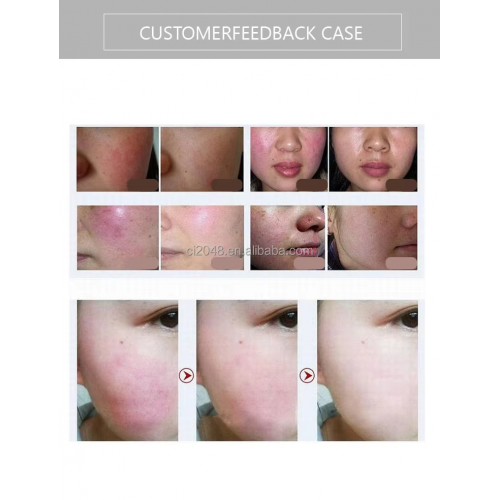 Multi functional 3-in-1 ice titanium laser hair removal OPT ND-YAG diode laser hair removal beauty machine