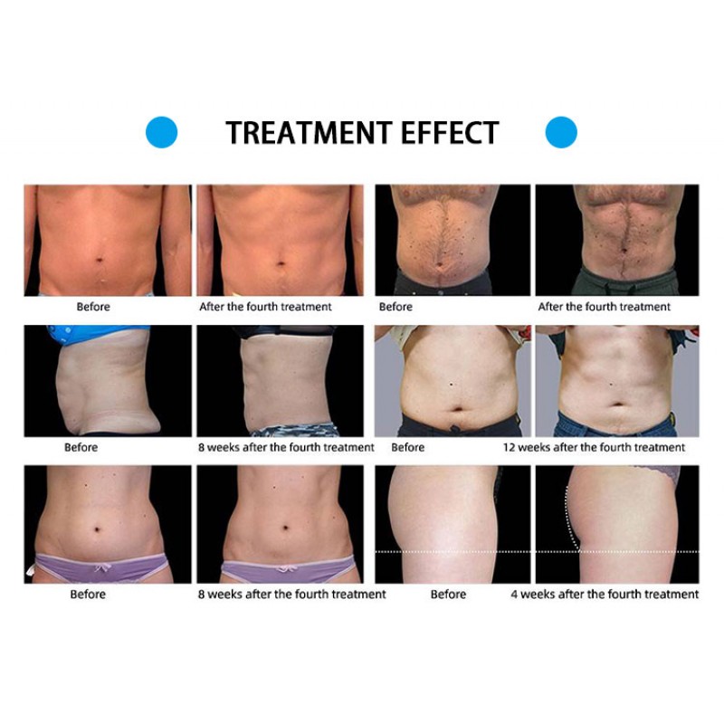  EMS Slimming Machine RF 2 Handles Body EMS NEO With RF Weight loss Skin Tightening Muscle Building 