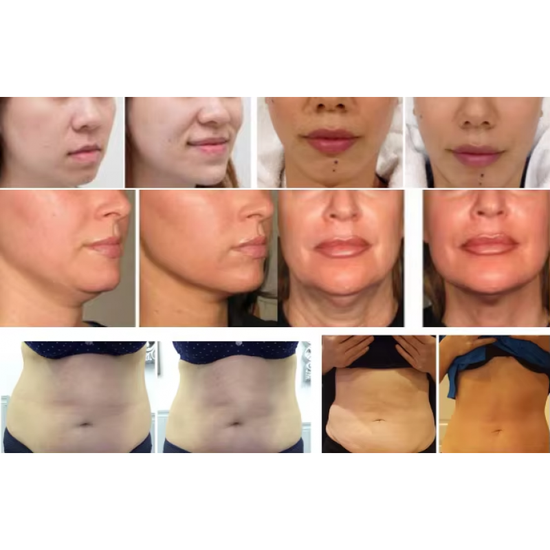 200000 Shots 12 Lines Beautemax Vmax 4d Hifu High Intensity Focused Ultrasound V Max 