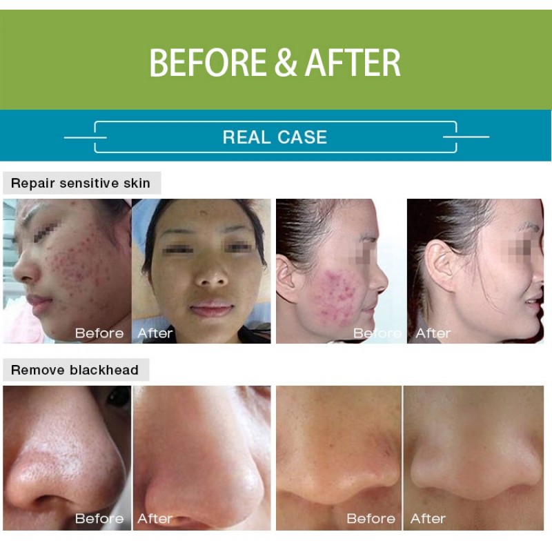 H2O2 Hydro clean skin care Aqua Peeling beauty personal care home use facial beauty machine 